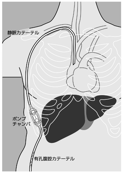 デンバーシャントの構造を示した模式図